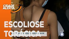 Jovem com escoliose torácica grave precisa de ajuda