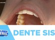 Extração do dente siso requer cuidados especiais