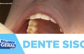 Extração do dente siso requer cuidados especiais