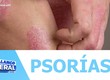 Dia mundial da psoríase chama atenção para doença crônica cercada de mitos e preconceitos