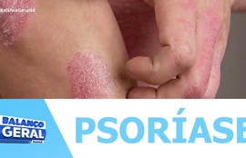 Dia mundial da psoríase chama atenção para doença crônica cercada de mitos e preconceitos