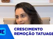 Cresce o número de procedimentos para remoção de tatuagens