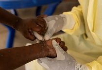 Brasil registra 88 casos de Mpox em 2026; saiba como evitar a doença