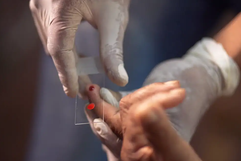 SUS passa a oferecer novo tratamento contra malária para crianças