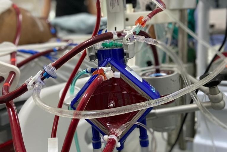 Paciente Covid-19 recebe tratamento que funciona como coração e pulmão artificiais no Hospital Cirurgia
