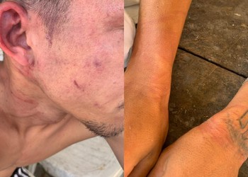 Homem denuncia agressão e tortura praticadas por policiais em São Cristóvão