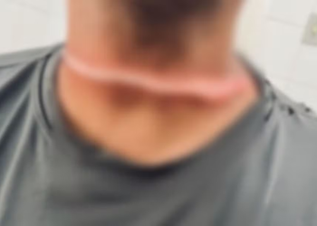 Motociclista fica ferido ao ser atingido por fio em cruzamento movimentado de Aracaju