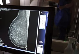 Lei garante mamografia pelo SUS para mulheres a partir dos 40 anos