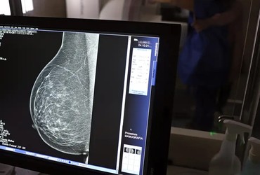 Lei garante mamografia pelo SUS para mulheres a partir dos 40 anos