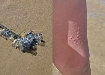 Caravelas provocam queimaduras em banhistas na Praia da Costa