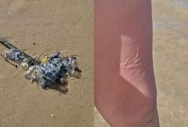 Caravelas provocam queimaduras em banhistas na Praia da Costa