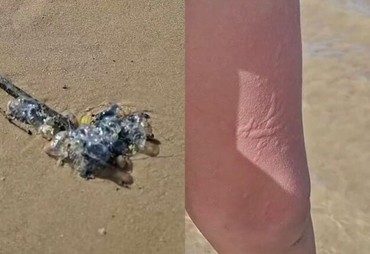 Caravelas provocam queimaduras em banhistas na Praia da Costa