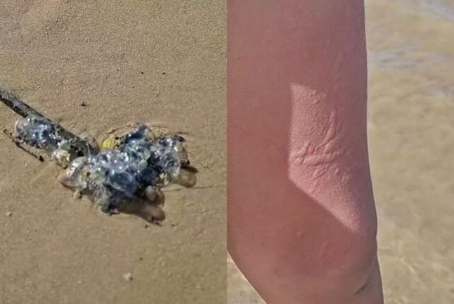 Caravelas provocam queimaduras em banhistas na Praia da Costa